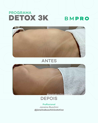 Antes e depois com o DETOX 3K — profissional Janaina Buschini (@janainabuschiniestetica)