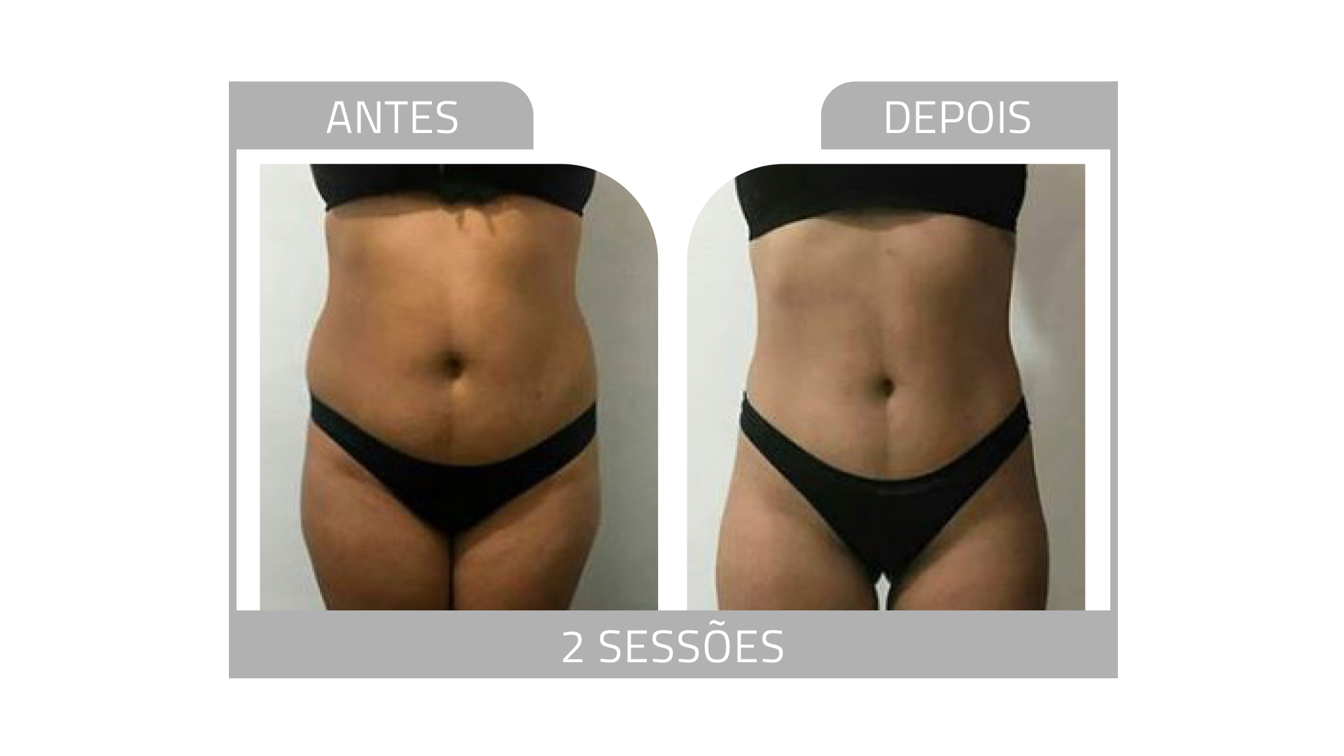 Antes e depois de corpo com o DETOX 3K — 2 sessões